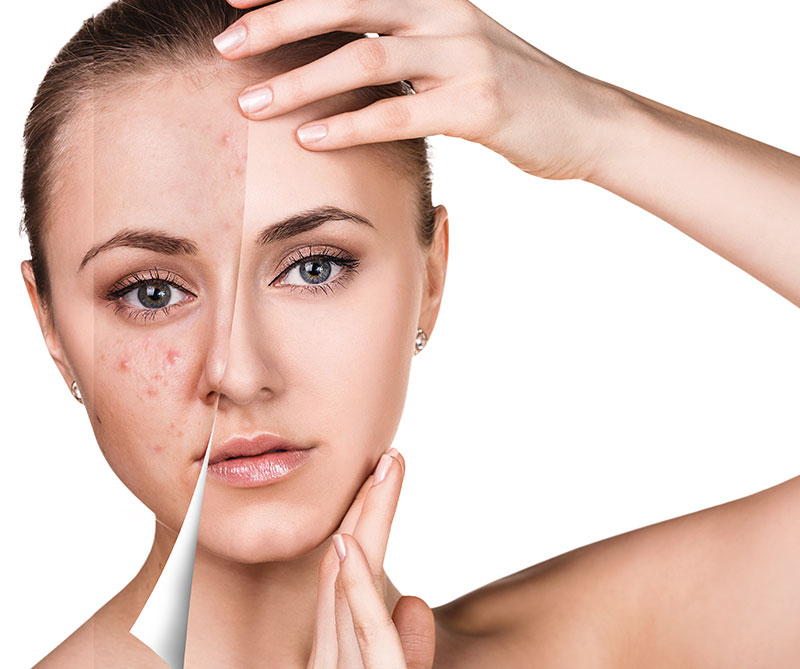 Βαθύς Καθαρισμός Προσώπου σε γυναίκα